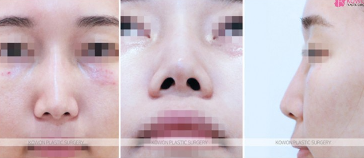 Q. 미간 콧대 수술 고민 콧대 수술 부작용과 재수술 고려 포인트 사진 5
