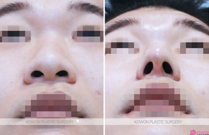 Q. 코수술 귀연골 통증, 남자 코수술 부작용일까? 원인과 대처법 사진 6