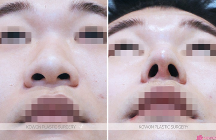 Q. 코수술 귀연골 통증, 남자 코수술 부작용일까? 원인과 대처법 사진 7