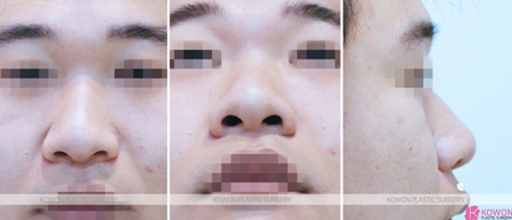 Q. 코수술 귀연골 통증, 남자 코수술 부작용일까? 원인과 대처법 사진 5