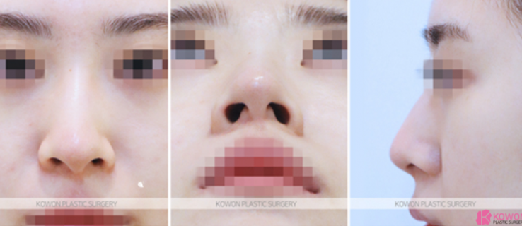 Q. 코절골술과 코수술 코끝 올리기 어떤게 맞을까요? 사진 4