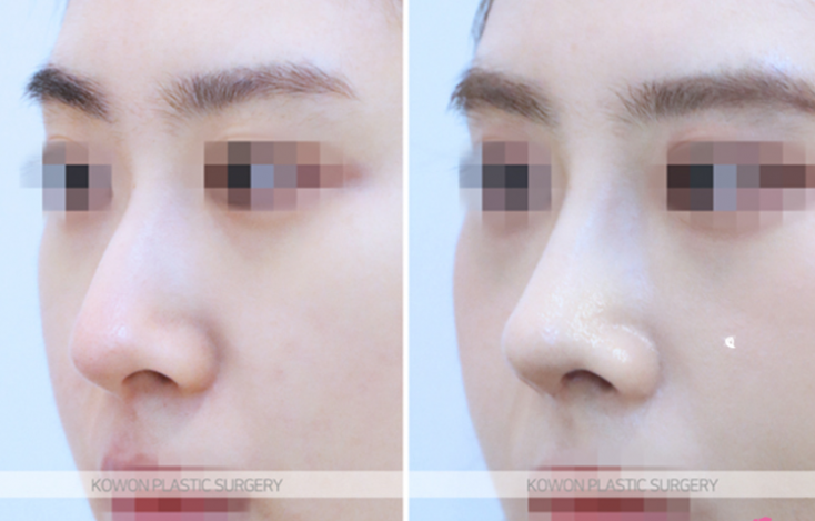 Q. 코절골술과 코수술 코끝 올리기 어떤게 맞을까요? 사진 6