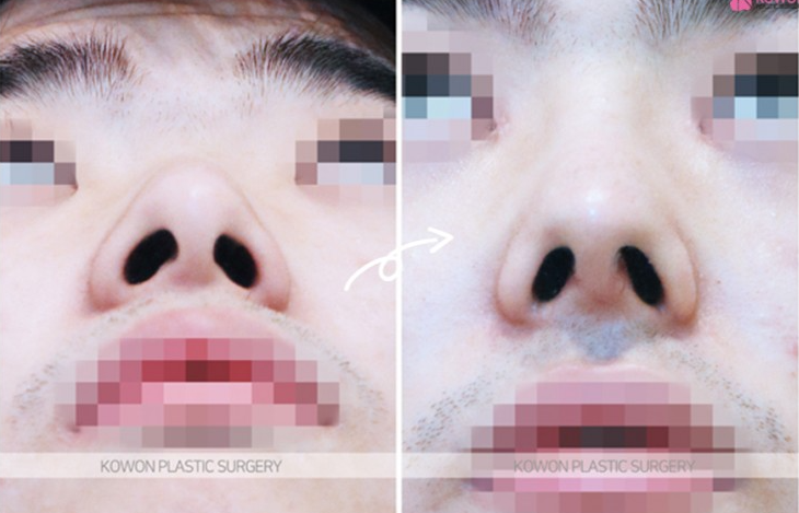 Q. 강남 남자 코성형 단순 트러블인지? 코염증 재수술 고민 해결