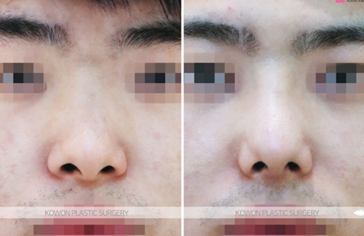 Q. 강남 남자 코성형 단순 트러블인지? 코염증 재수술 고민 해결 사진 7