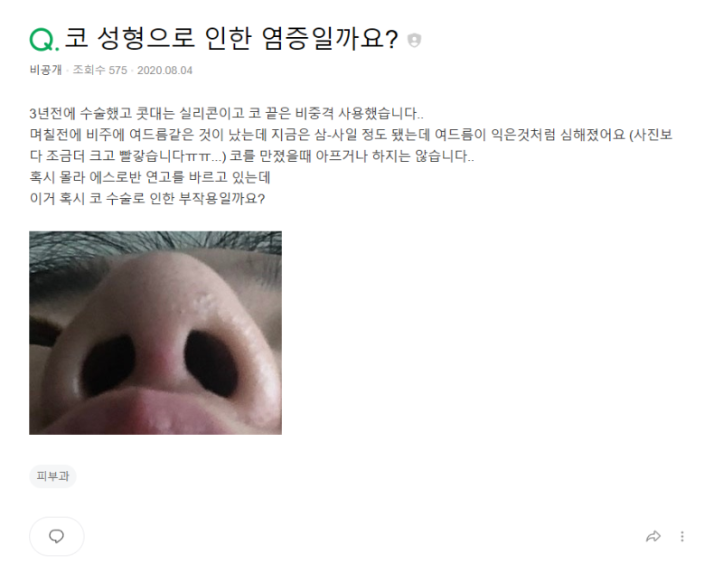 Q. 강남 남자 코성형 단순 트러블인지? 코염증 재수술 고민 해결 사진 2