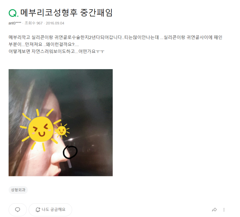Q. 매부리코 수술 부작용이 걱정될 때 확인할 점 알아보기 사진 2
