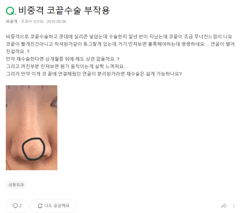 Q. 강남 코 재수술 필요한 코끝수술부작용일까요? 사진 2