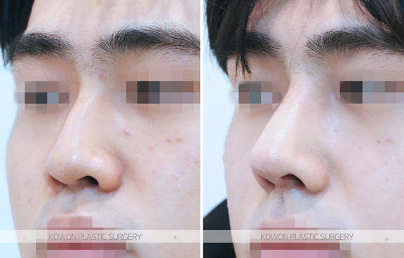 Q. 남자코성형잘하는곳에서 소개하는 남자매부리코수술의 올바른 방향 사진 5