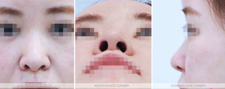 Q. 화살코코끝수술 후 고민, 어떤 코수술종류가 필요한지 궁금해요 사진 4