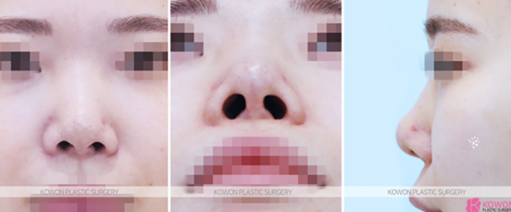 Q. 코수술 한달 붓기는 어느정도가 정상인지 궁금해요 사진 5