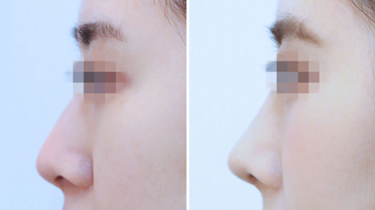 Q. 웃을때 화살코 수술 필요한데, 퍼진코수술 정보가 궁금해요 사진 5
