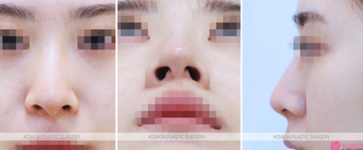 Q. 웃을때 화살코 수술 필요한데, 퍼진코수술 정보가 궁금해요 사진 4