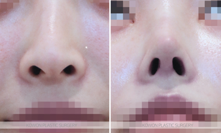 Q. 코수술 콧대 4mm 실리콘은 티 날까봐 걱정입니다 사진 7