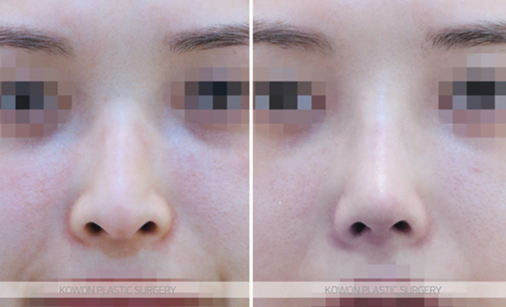 Q. 코수술 콧대 4mm 실리콘은 티 날까봐 걱정입니다 사진 8