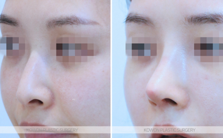 Q. 코수술 콧대 4mm 실리콘은 티 날까봐 걱정입니다 사진 6