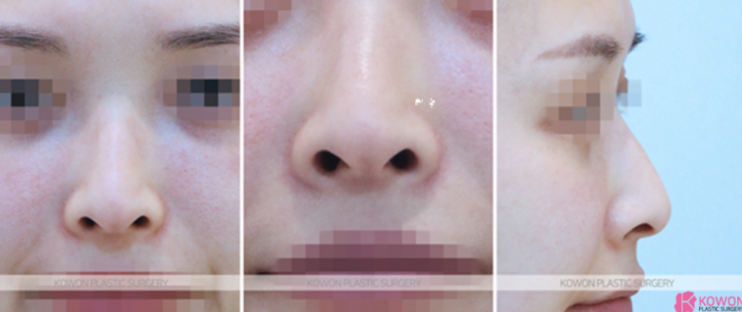 Q. 코수술 콧대 4mm 실리콘은 티 날까봐 걱정입니다 사진 4
