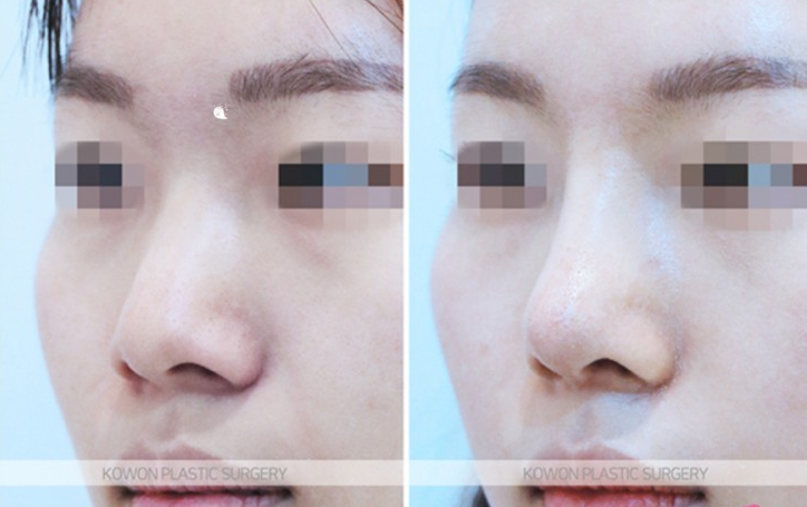 Q. 코수술 한달 붓기는 어느 정도일까? 코성형 전 궁금증들 사진 7