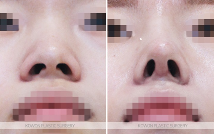 Q. 코수술 한달 붓기는 어느 정도일까? 코성형 전 궁금증들 사진 9
