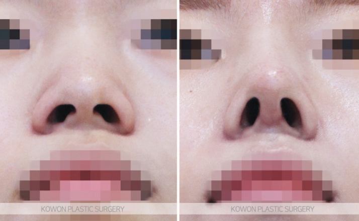 Q. 코수술 한달 붓기는 어느 정도일까? 코성형 전 궁금증들 사진 6