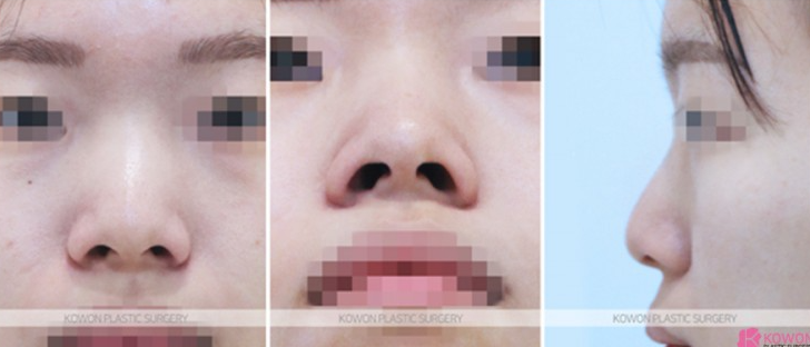 Q. 코수술 한달 붓기는 어느 정도일까? 코성형 전 궁금증들 사진 5