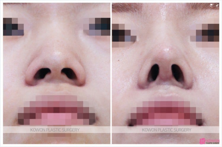 Q. 코수술 후 코안 점막 부음(코수술부작용)일까요?