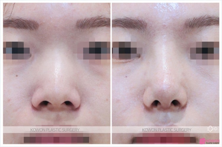 Q. 코수술 후 코안 점막 부음(코수술부작용)일까요? 사진 8