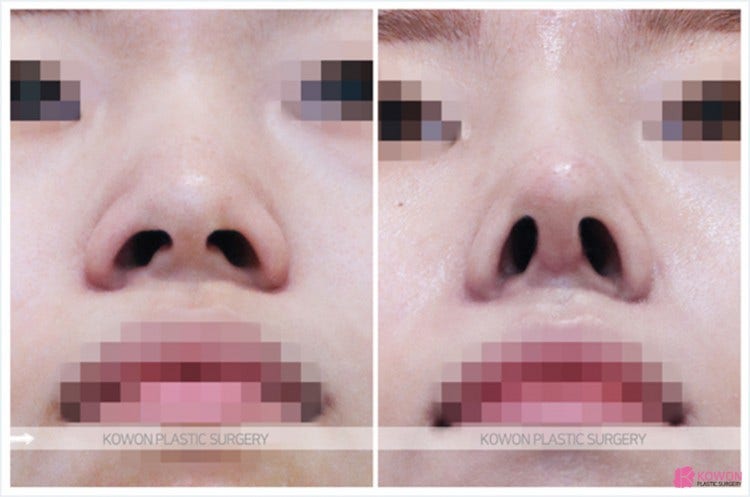 Q. 코수술 후 코안 점막 부음(코수술부작용)일까요? 사진 7