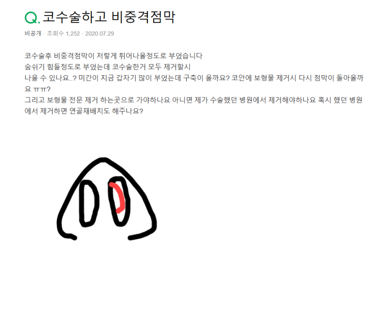 Q. 코수술 후 코안 점막 부음(코수술부작용)일까요? 사진 2