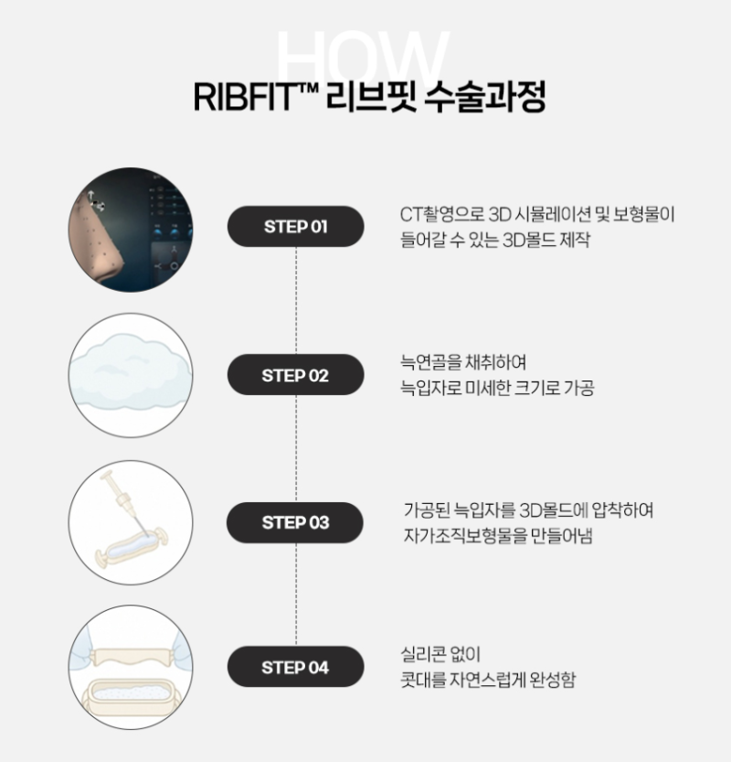 Q. 코성형 티 안나는 방법? A. 자가조직 보형물 리브핏으로 사진 7