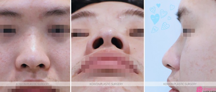 Q. 콧대뼈 절골과 코끝성형으로 큰 코 개선이 가능할까요? (남자코성형전후 질문) 사진 3