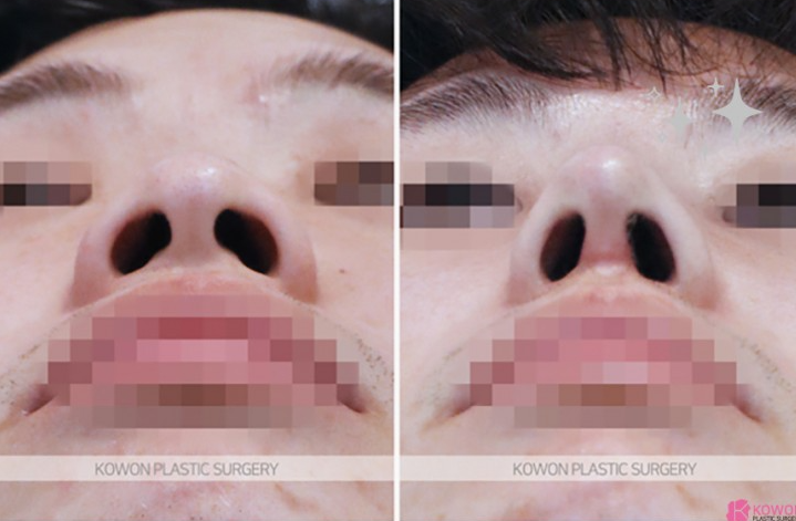 Q. 콧대뼈 절골과 코끝성형으로 큰 코 개선이 가능할까요? (남자코성형전후 질문) 사진 5