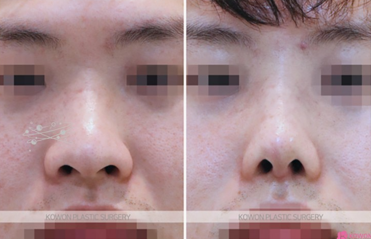 Q. 콧대뼈 절골과 코끝성형으로 큰 코 개선이 가능할까요? (남자코성형전후 질문) 사진 7