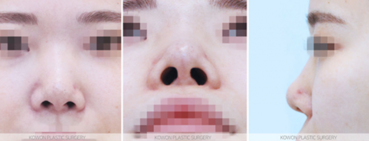 Q. 코수술 실리콘 변화, 재수술이 필요한 경우일까? 사진 6