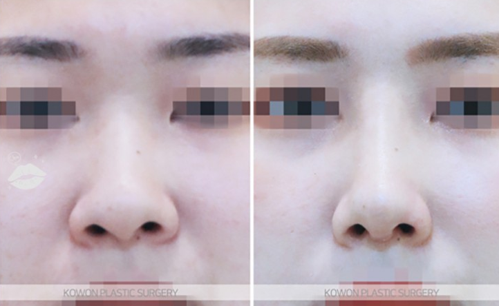 Q. 코수술 부작용일까요? 안경을 착용하면 통증이 느껴져요