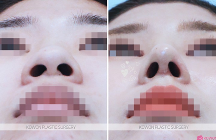 Q. 코수술 부작용일까요? 안경을 착용하면 통증이 느껴져요 사진 5