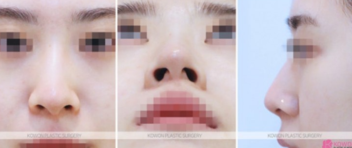 Q. 비개방 코수술 가능할까? 전신마취 걱정까지 한 번에 정리 사진 4