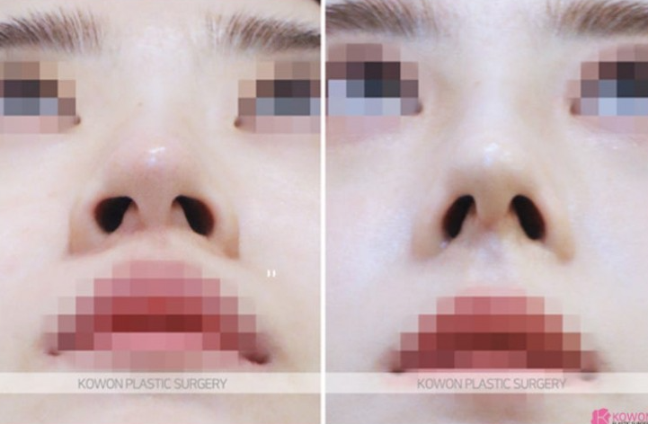 Q. 비개방 코수술 가능할까? 전신마취 걱정까지 한 번에 정리 사진 8