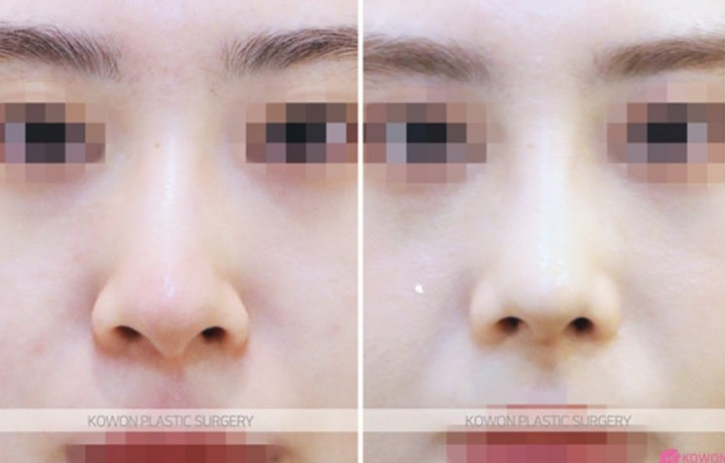 Q. 비개방 코수술 가능할까? 전신마취 걱정까지 한 번에 정리 사진 9
