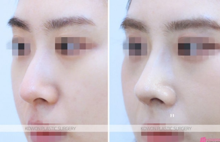 Q. 비개방 코수술 가능할까? 전신마취 걱정까지 한 번에 정리 사진 6