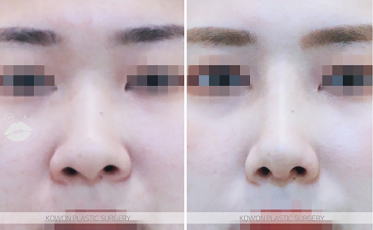 Q. 코수술후 염증 걱정, 실밥 제거 후 심한 통증 정상일까? 사진 7