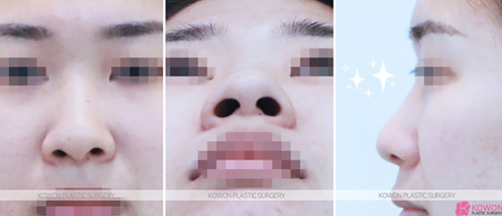 Q. 코수술후 염증 걱정, 실밥 제거 후 심한 통증 정상일까? 사진 3