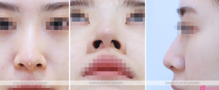 Q. 휜코성형 고민, 양악수술 전 고려해야 할 코수술 방향 사진 3