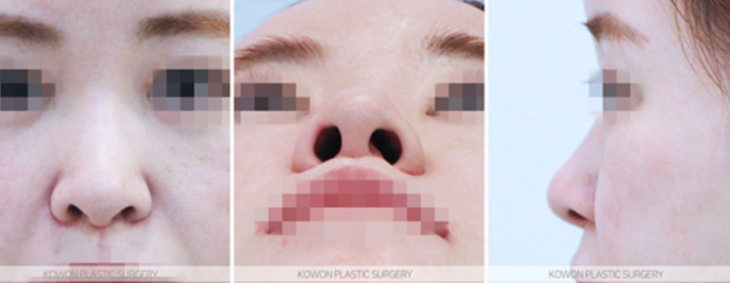 Q. 긴코·퍼진코 재수술 고민, 자연스러운 코수술 결과를 위한 핵심은? 사진 4