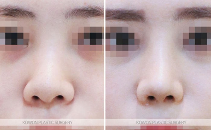 Q. 복코수술전후 변화와 함께 확인하는 무보형물코수술 가능 여부 사진 6