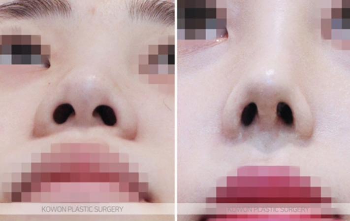Q. 복코수술전후 변화와 함께 확인하는 무보형물코수술 가능 여부 사진 7