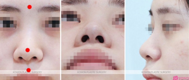 Q. 복코수술전후 변화와 함께 확인하는 무보형물코수술 가능 여부 사진 3