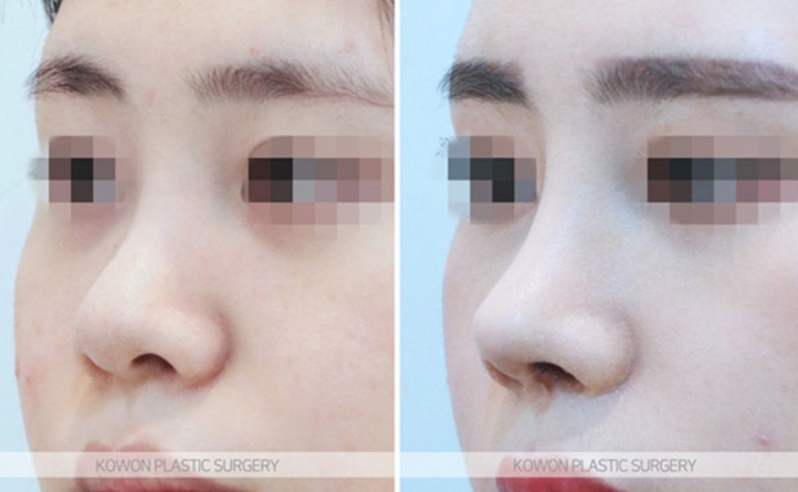 Q. 복코수술전후 변화와 함께 확인하는 무보형물코수술 가능 여부
