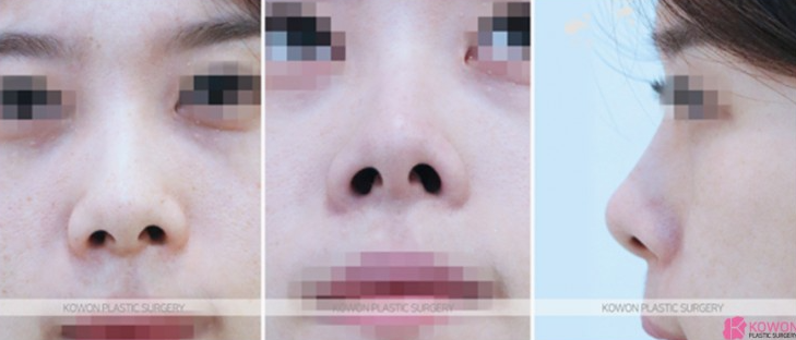 Q. 코수술 후 돼지코가 되지 않는데, 실리콘 제거하면 해결 될까요? 사진 4