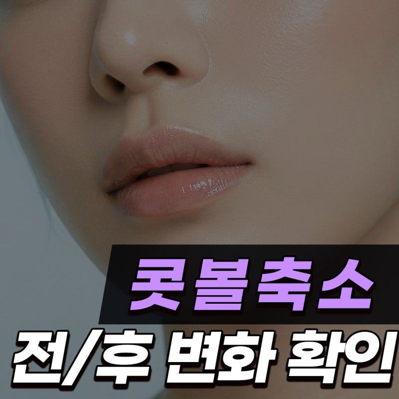 Q. 콧볼축소수술전후 변화가 클까요? 콧구멍 노출과 들린코 고민 정리