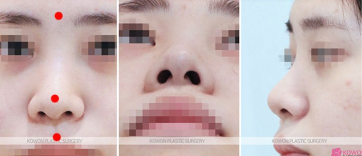 Q. 코성형 회복기간 동안 붓기와 피고임 구분, 콧대재수술 시기 정리 사진 3